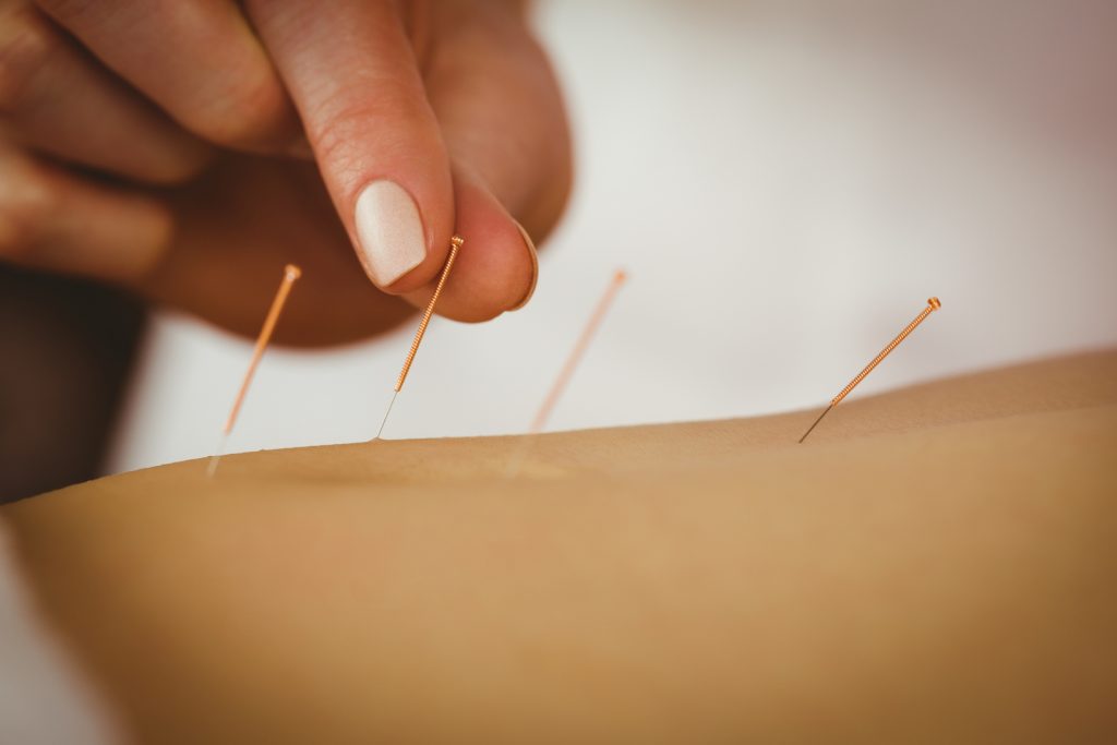 Stop met het roken van acupunctuur
